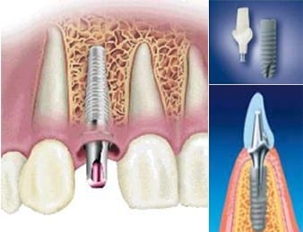 implant-dentaire