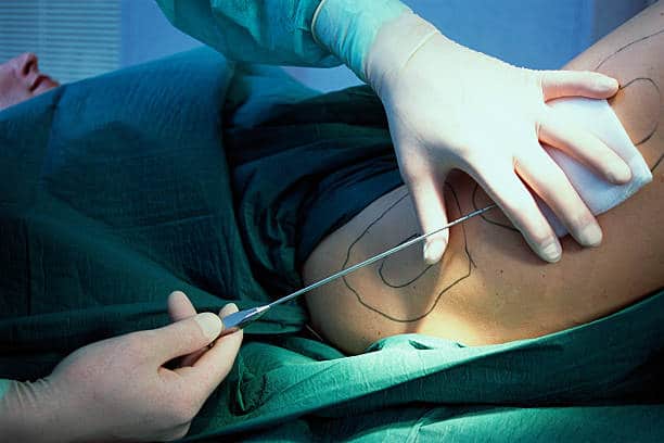 Chirurgie esthétique, liposuccion de la cuisse d'une femme