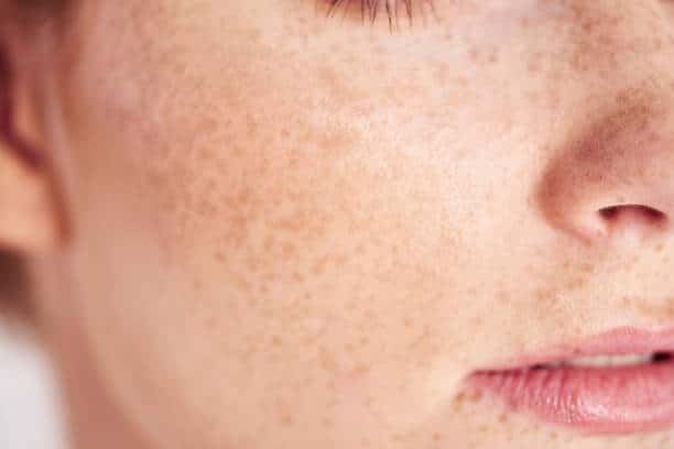 Femme avec des taches de rousseur à la belle peau saine et sans boutons après un masque à l'argile verte